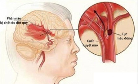 Đột quỵ não là gì?