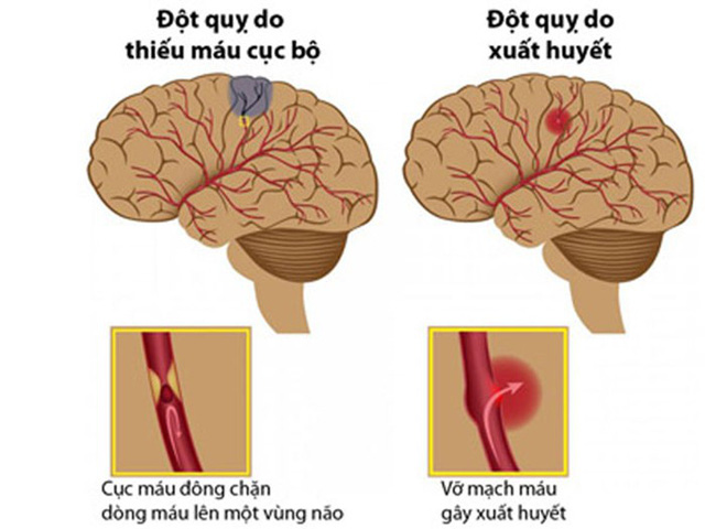 Đột quỵ não là gì?