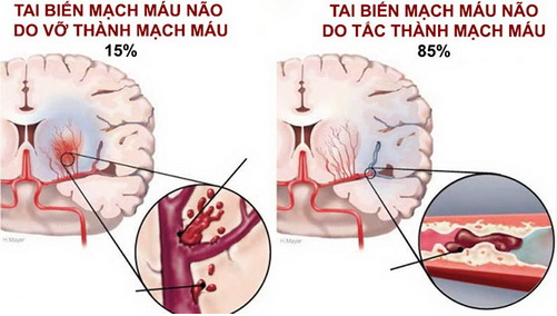 Tai biến mạch máu não