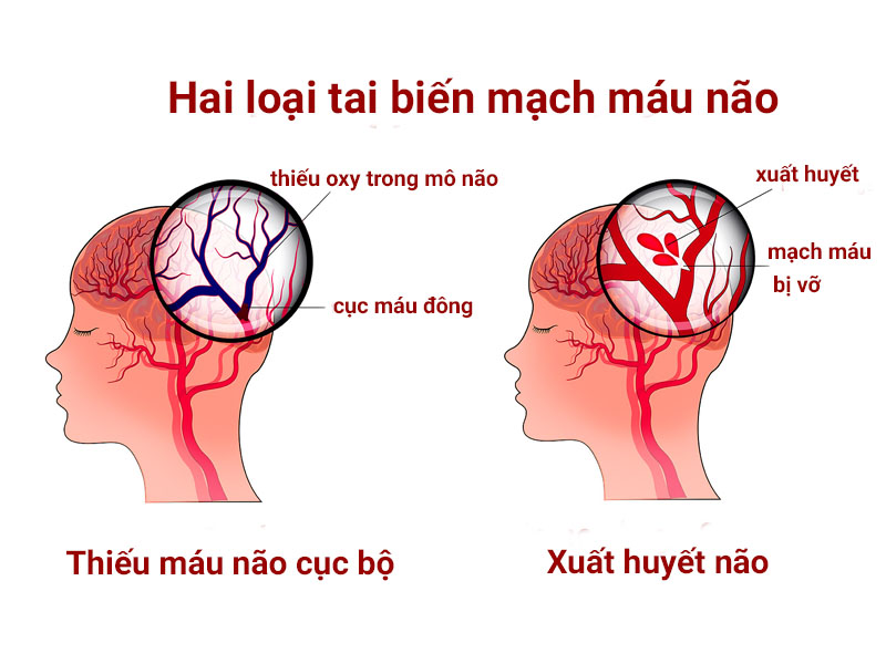 Tai biến mạch máu não ở người già