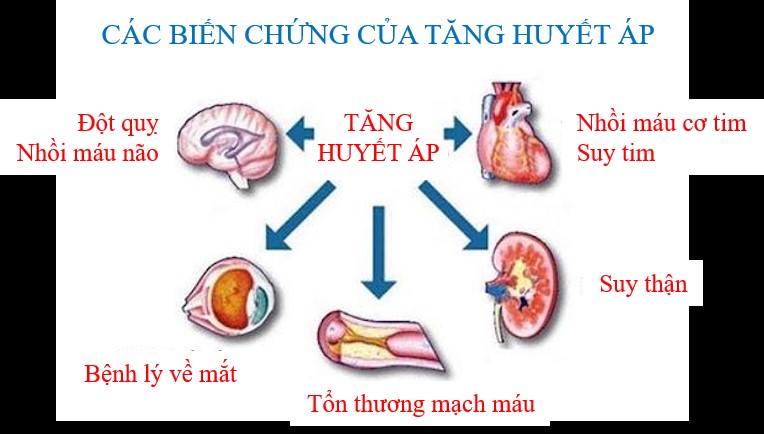 Tai biến mạch máu não do tăng huyết áp