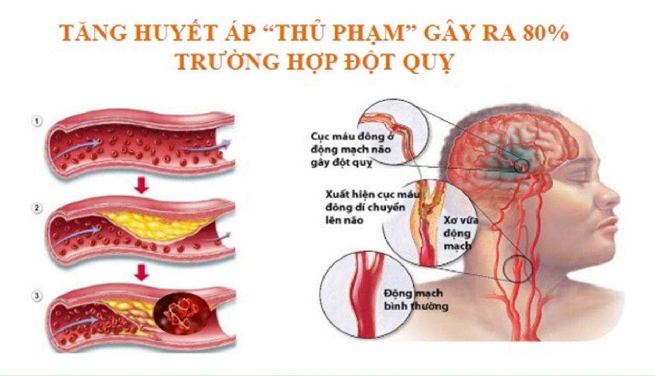 Tai biến mạch máu não do tăng huyết áp