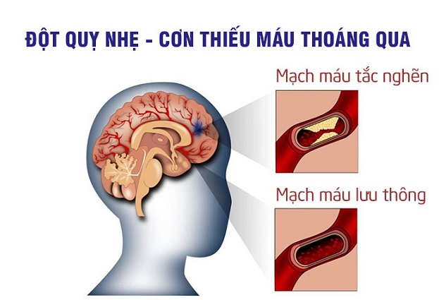 Cơn thiếu máu não thoáng qua