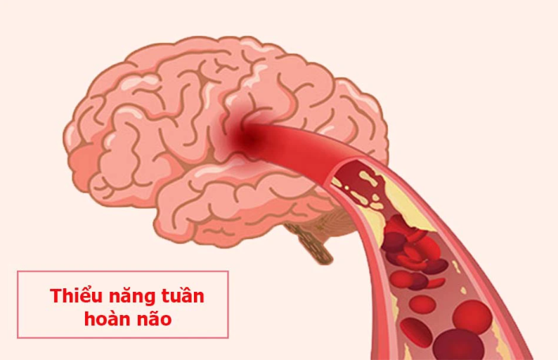 bài thuốc chữa thiểu năng tuần hoàn não