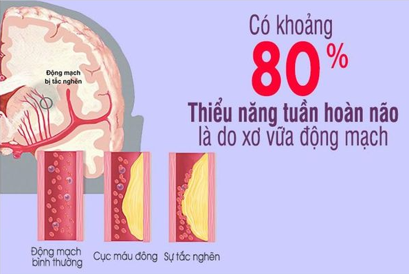 Biến chứng thiểu năng tuần hoàn não