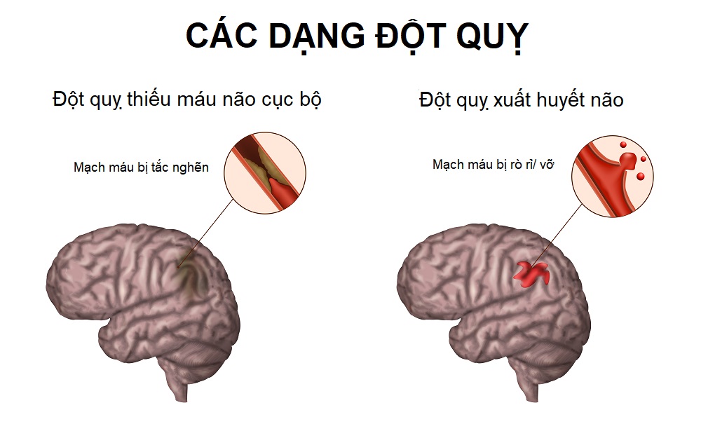 phân biệt đau nửa đầu và đột quỵ