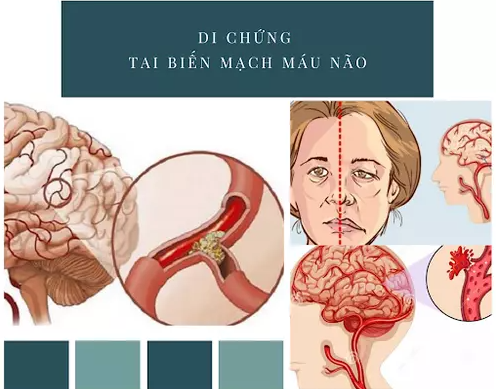  di chứng do tai biến mạch máu não