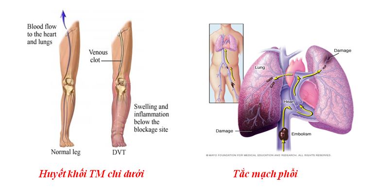  di chứng do tai biến mạch máu não