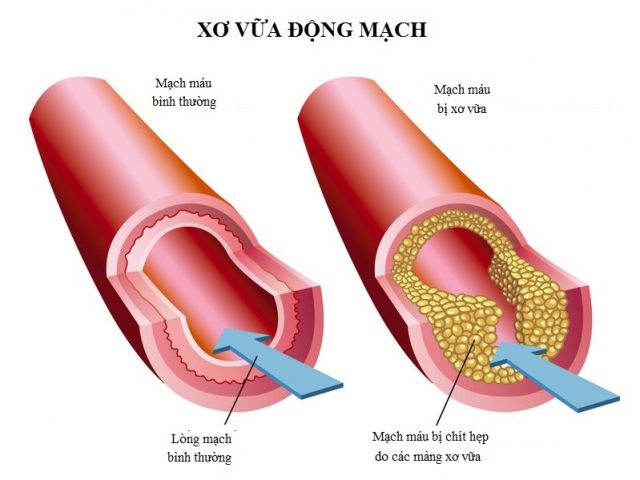 Cách phòng xơ vữa động mạch