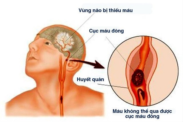 Đột quỵ nhồi máu não sống được bao lâu?