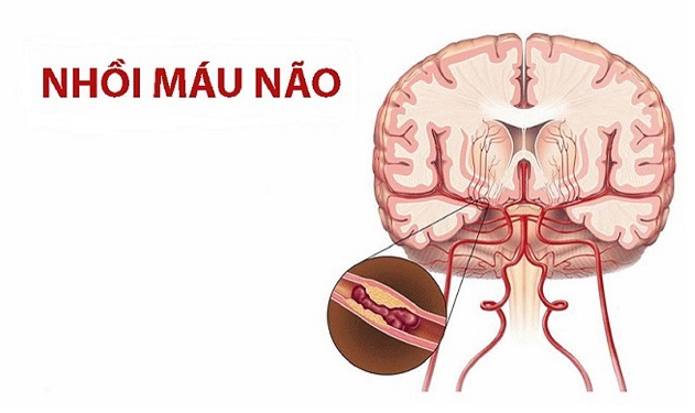 Đột quỵ nhồi máu não