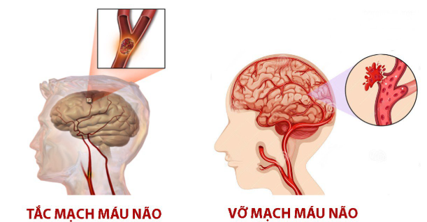 Tai biến mạch máu não có di truyền không?