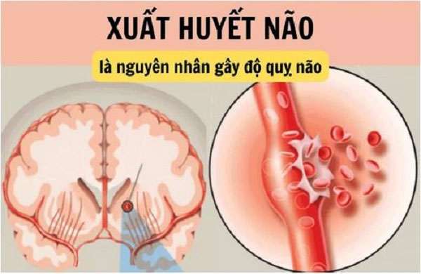 phẫu thuật xuất huyết não