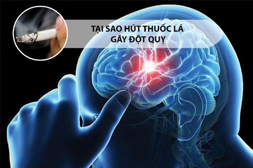 Hút thuốc lá làm tăng nguy cơ đột quỵ