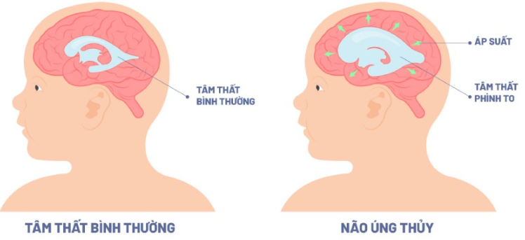 Xuất huyết dưới nhện