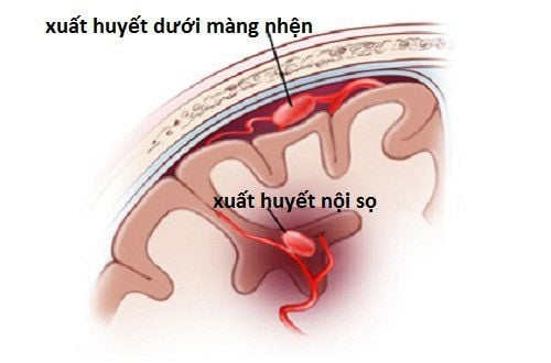 Xuất huyết dưới nhện