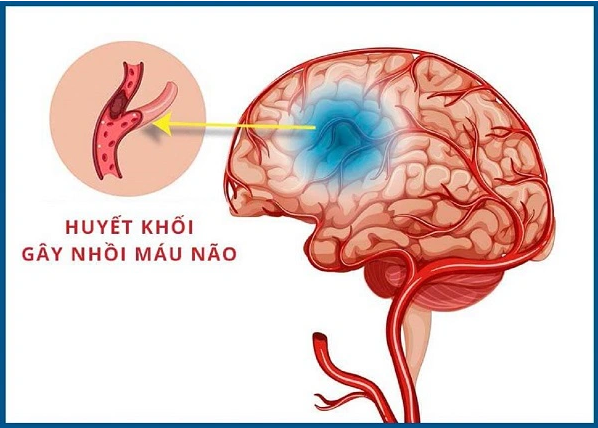 Điều trị đột quỵ nhồi máu não theo Đông y