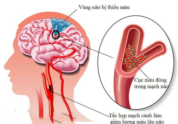 Chẩn đoán thiểu năng tuần hoàn não