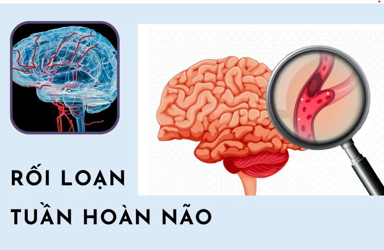 Rối loạn tuần hoàn não