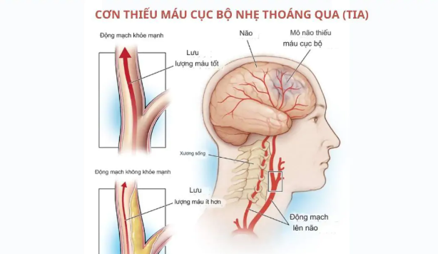 Điều trị cơn thiếu máu não thoáng qua