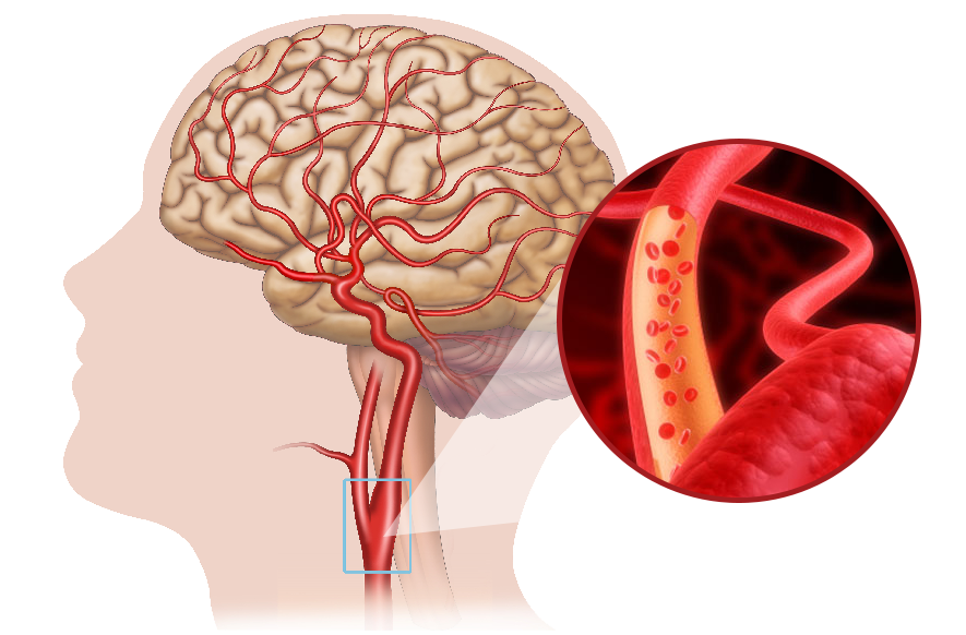 Bài tập tăng cường lưu thông máu lên não