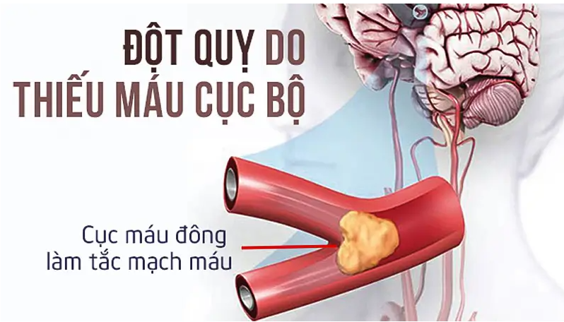 Tầm soát đột quỵ bao lâu 1 lần
