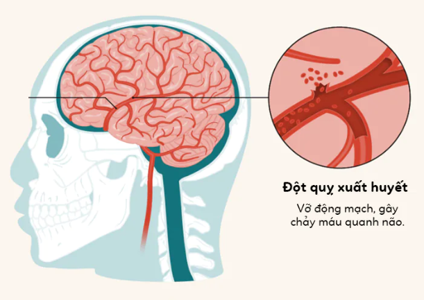 Tầm soát đột quỵ bao lâu 1 lần