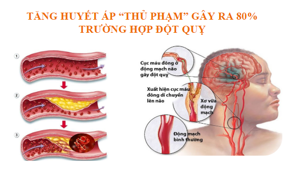Tầm soát đột quỵ bao lâu 1 lần
