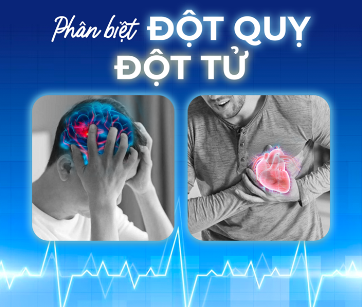 phân biệt đột tử và đột quỵ