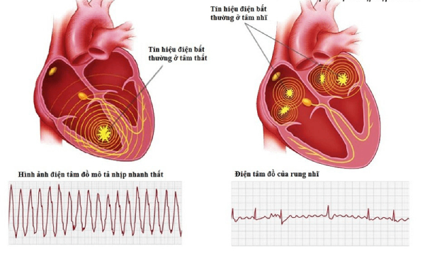 phân biệt đột tử và đột quỵ