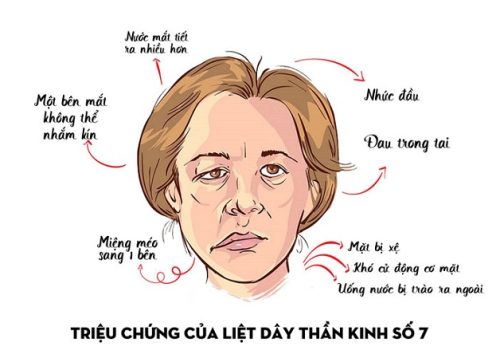 Liệt mặt sau đột quỵ