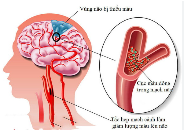 Thiếu máu não nên ăn trái cây gì