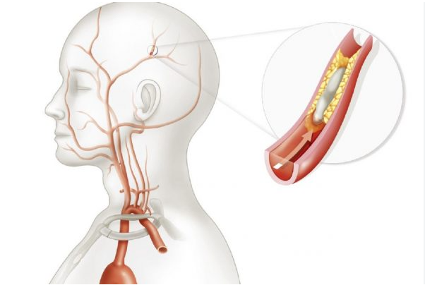 Thiếu máu não mạn tính