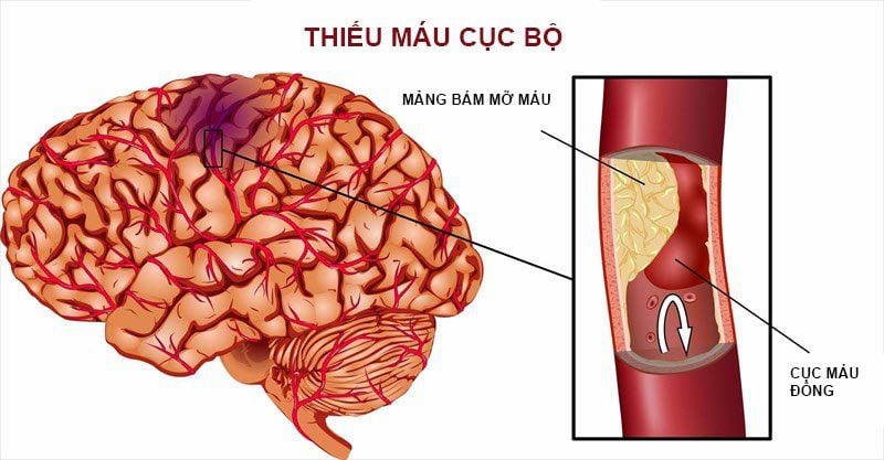 Các yếu tố nguy cơ gây thiểu năng tuần hoàn não