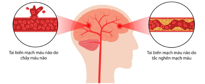 Phương pháp tầm soát tai biến mạch máu não: Chìa khóa để bảo vệ não bộ