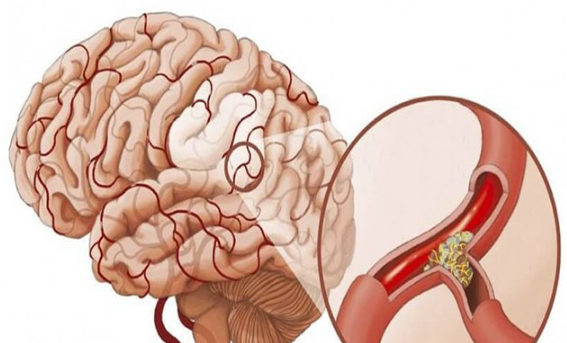 Co thắt mạch máu não
