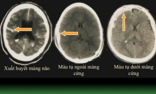 Tai biến mạch máu não không nói được: Nguyên nhân và cách điều trị