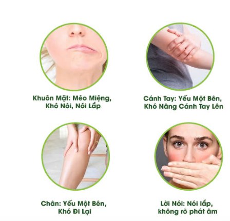 Tai biến mạch máu não không nói được