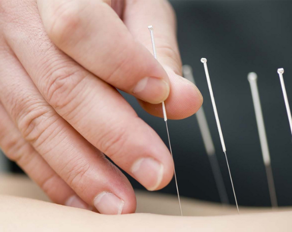 Bị tai biến mạch máu não có nên châm cứu không?