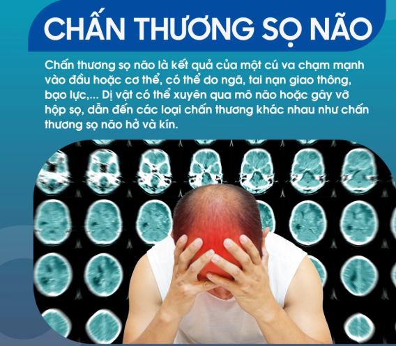 Vì sao chấn thương sọ não làm tăng nguy cơ đột quỵ?