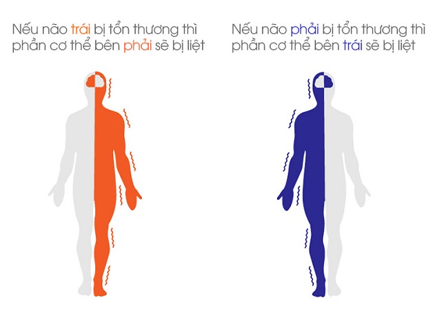 Tai biến liệt nửa người bên trái