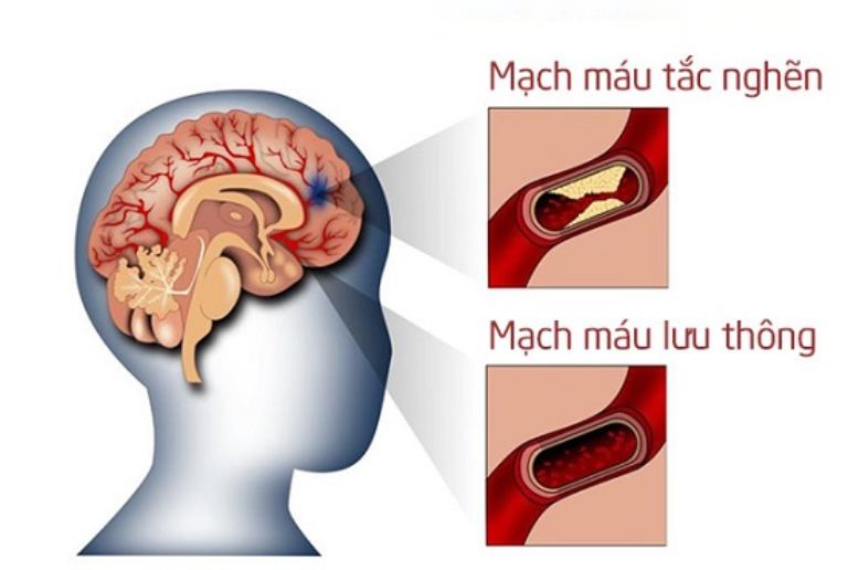 Tắc mạch máu não có nguy hiểm không? Làm thế nào để điều trị phòng ngừa biến chứng?