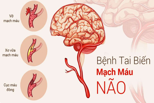 Nguyên nhân bị tai biến là gì? Bác sĩ cảnh báo các yếu tố nguy cơ cần tránh