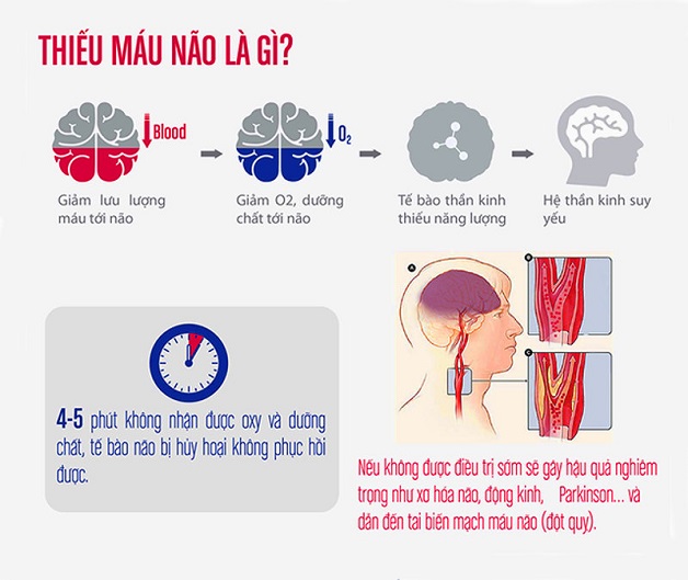 Dấu hiệu thiếu máu não