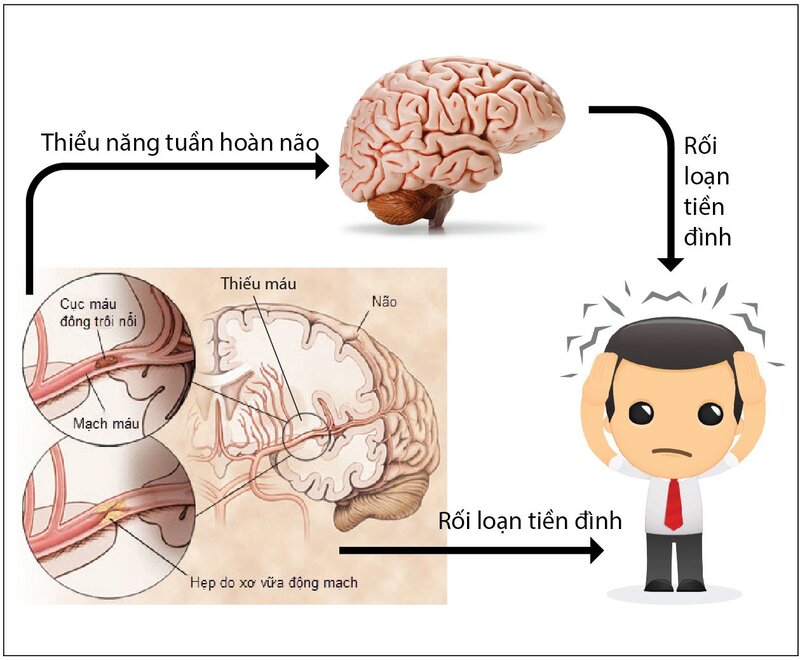 Chóng mặt ù tai