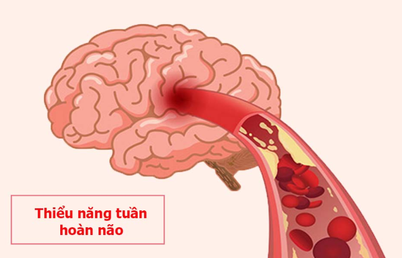 Chóng mặt ù tai
