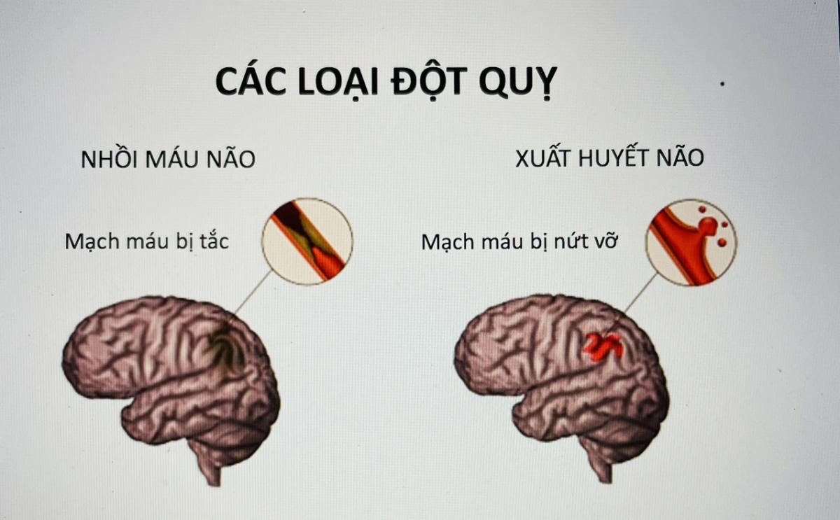 Đột quỵ ban đêm