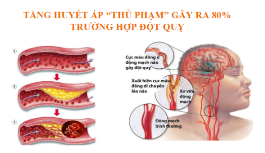 Đột quỵ ban đêm